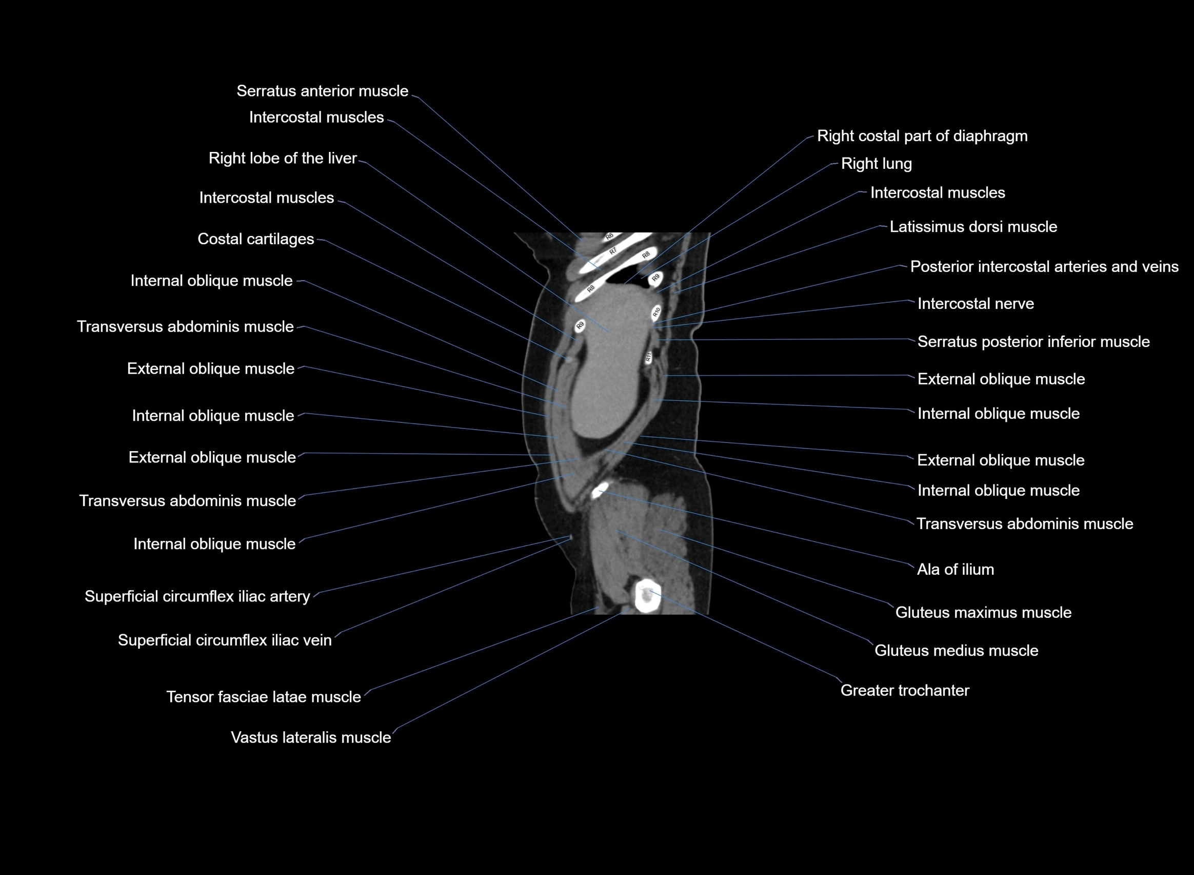 CT Abdomen sagittal cross sectional anatomy labelled radiology image -00101.webp